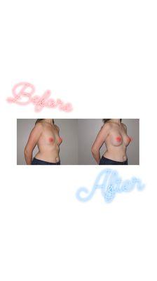 Before and after breast augmentation