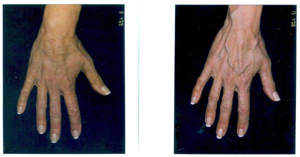 Hand veins before & after by ambulatory phlebectomy.
Office procedure in one setting, local anesthesia and no down time