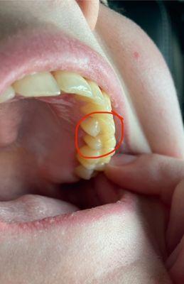 Left side of bicuspids. How my teeth should look.