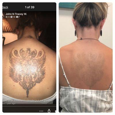 After 1st treatment is on left and right before my 6th treatment is on right. Neck tattoo is just about gone.