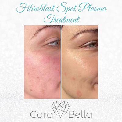 Fibroblast Plasma Skin treatment for hyperpigmentation