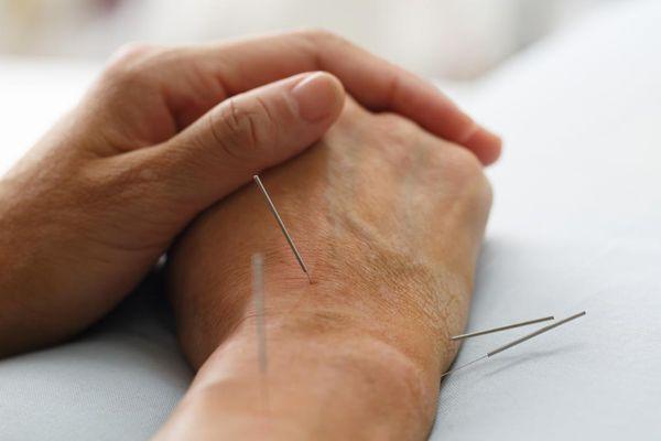 Acupuncture Safe and very effective