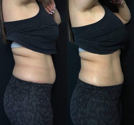 Results immediately after Non-Invasive Laser Lipo