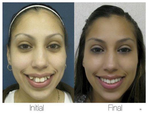 Severe crowding  Before / After Invisalign Teen