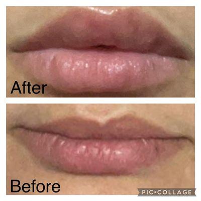 Natural look lips, get rid of those lines by filling the volume lost and correcting uneven sides