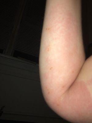 A set of bites and the ensuing eczema. August 2018.