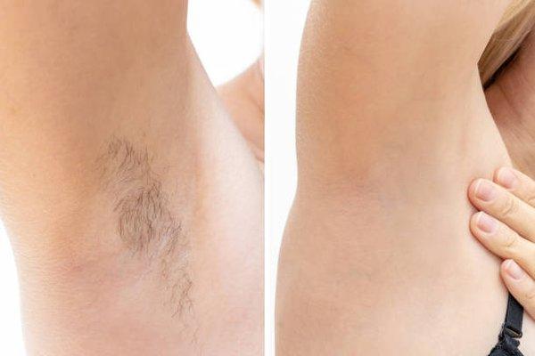 Laser hair removal, before and after.