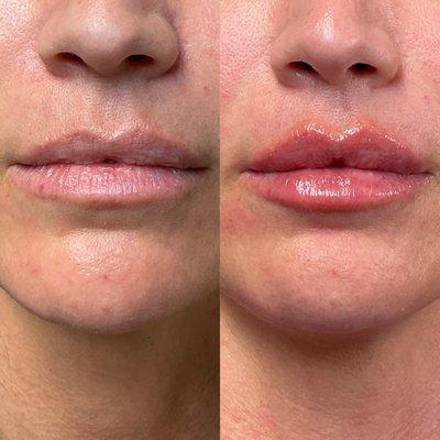 Before and after lip filler