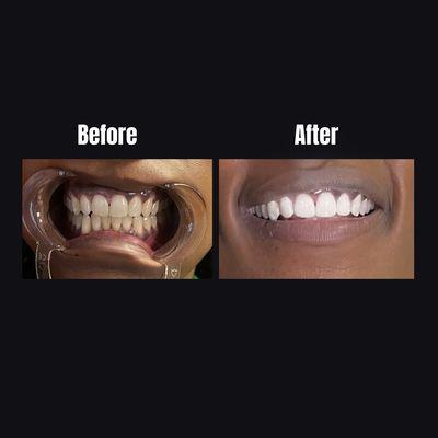 Laser Teeth whitening