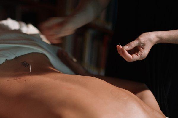 An acupuncture treatment at Peony.