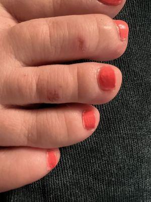 Pedicure ... burns from the callus removing gel ?