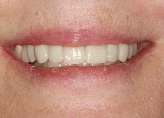 Our patient's smile after the smile design.