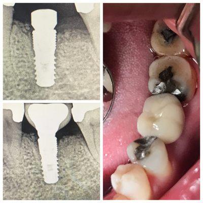 Missing Molar, restore with implant and porcelain crown.