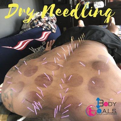 Dry Needling is amazing for rehab and recovery