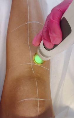 Legs Laser Hair Removal!