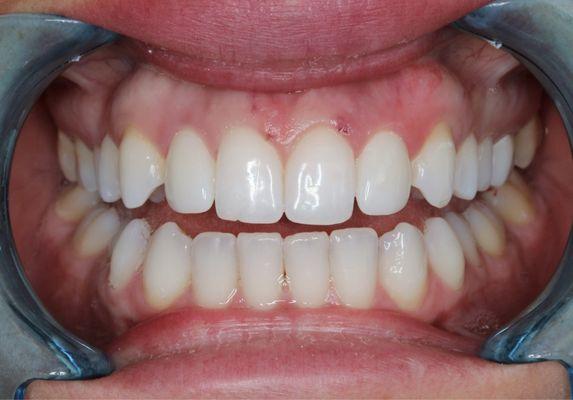 After photo of brand new veneers!!! Much better.