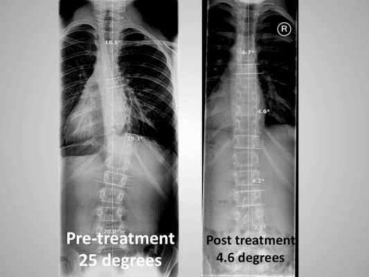 Non Surgical Scoliosis Treatment