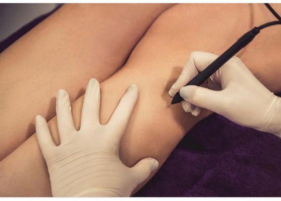 Electrolysis leg hair removal