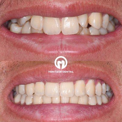 Our patient experienced a life-changing transformation with Invisalign!