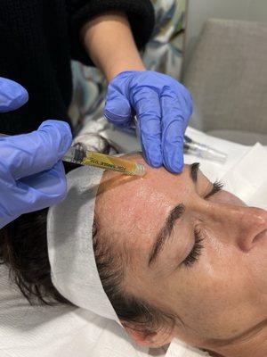 PRP (platelet-rich plasma) used for microneedling.