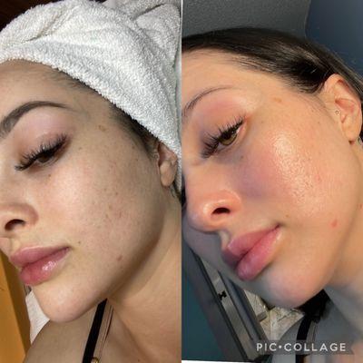 Facial Becore and after