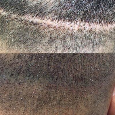 Hair Transplant scar camouflage process