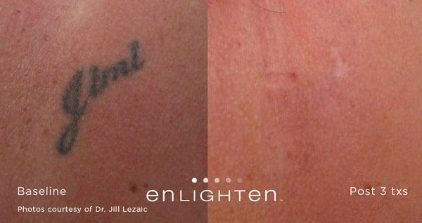 Enlighten Aesthetic of Cleveland - Name Tattoo Before and After - Cutera Enlighten Laser Tattoo Removal