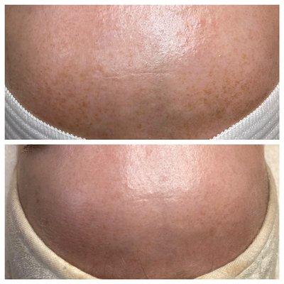 Top picture shows hyperpigmentation and the bottom picture is after three treatments!