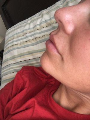 2 weeks after 2nd lip filler