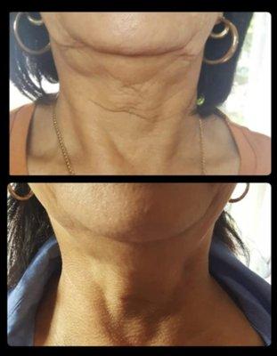 Cryo Fat Freeze for Chin plus Plasma Pen Neck Lift 409-454-9502