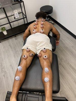 Cupping Therapy