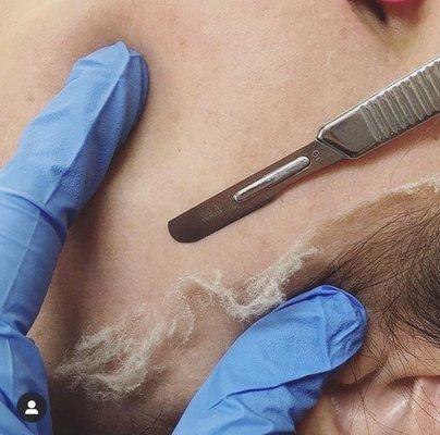 Dermaplaning is the very best advanced treatment to provide deep exfoliation and glowing skin! Recommended every 4 weeks for best results!