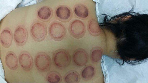 Look at my cupping back... bad shoulders! This is when I thought my back was on fire. Bad blood!