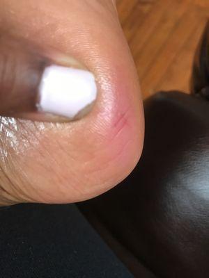 Chipped nail and cut heel