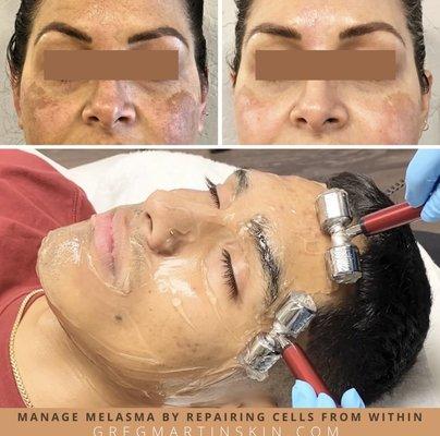 Melasma and Pigmentation Treatment with Microcurrent Cellular Therapy