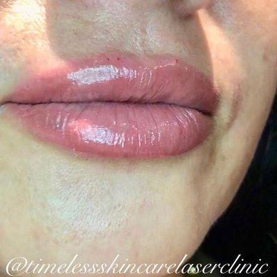 Lip Augmentation