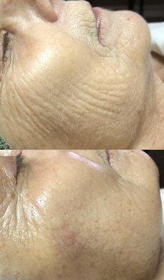 Anti- Aging Facial before (top); after (bottom)