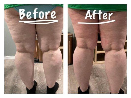 Treat cellulite and stretch marks in 5 minutes with CryoSculpting!