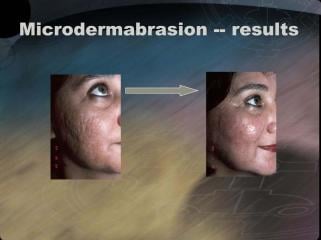 Safely Exfoliate Your Skin With Microdermabrasion From Essential Day Spa & Cosmetics