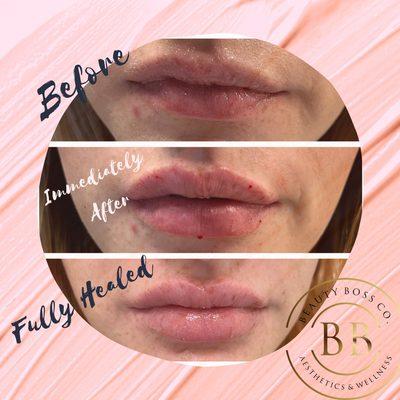 Lip Filler progression