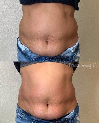 Clients first session of body sculpting. Top photo before any body sculpting. Bottom photo was taken after the first session.