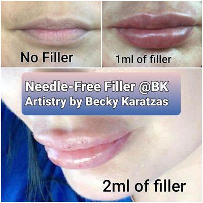 Needle-Free filler