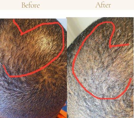 Micro scalp pigmentation. Is in purpose of adding the illusion of hair follicles  to thinning areas. This picture is the first session.