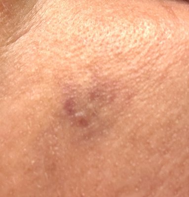 Bruised face from poor Novocain injection.