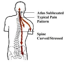 Atlas Subluxations Can Contribute to Scoliosis