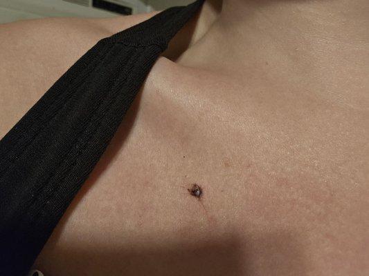 Dermal sinking into skin