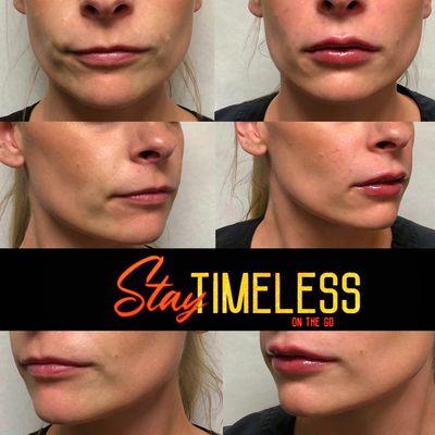 Lip filler treatment