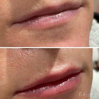 Versa Lip Filler