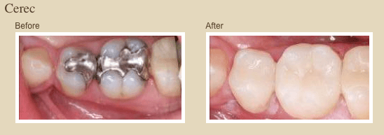 Cerec CAD/CAM Porcelain one visit dentistry