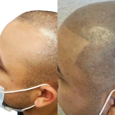 Scalp Micropigmentation